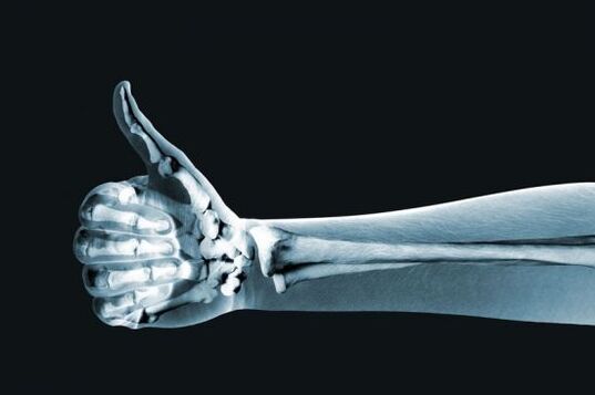 Рентгенография саусақтардың буындарындағы ауырсынуды анықтауға көмектеседі